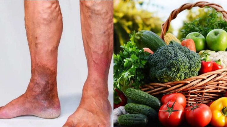 Eat this green vegetable in the problem of varicose veins, the symptoms will improve quickly